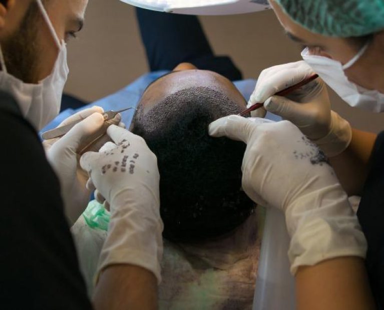 Giga Session Hair Transplant